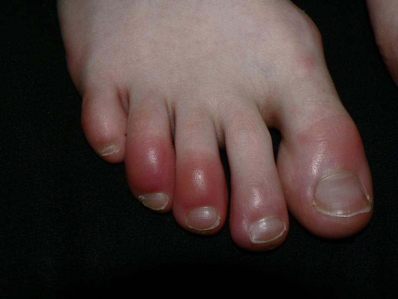 Do you have cold or swollen feet this winter?